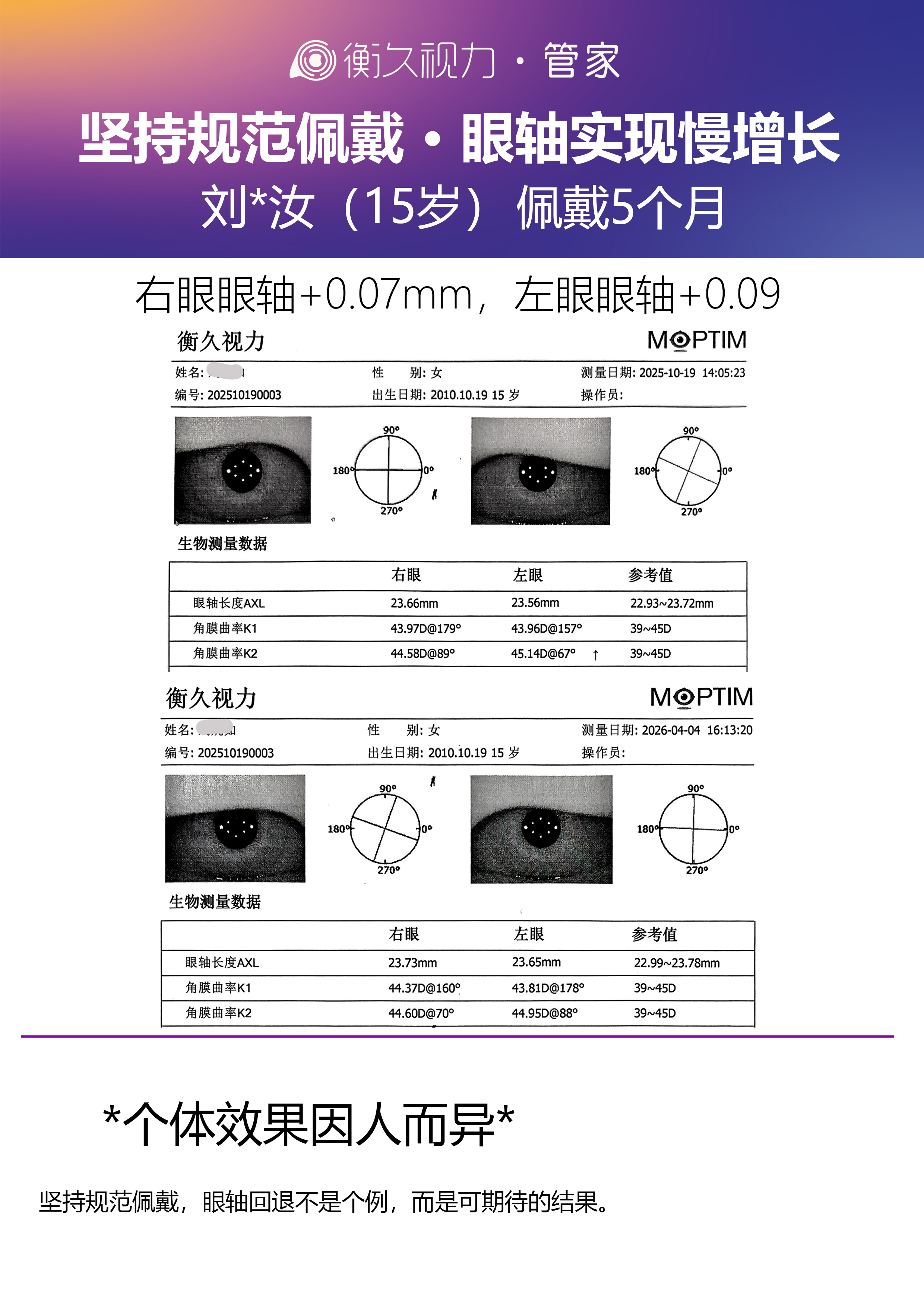 眼轴案例 01