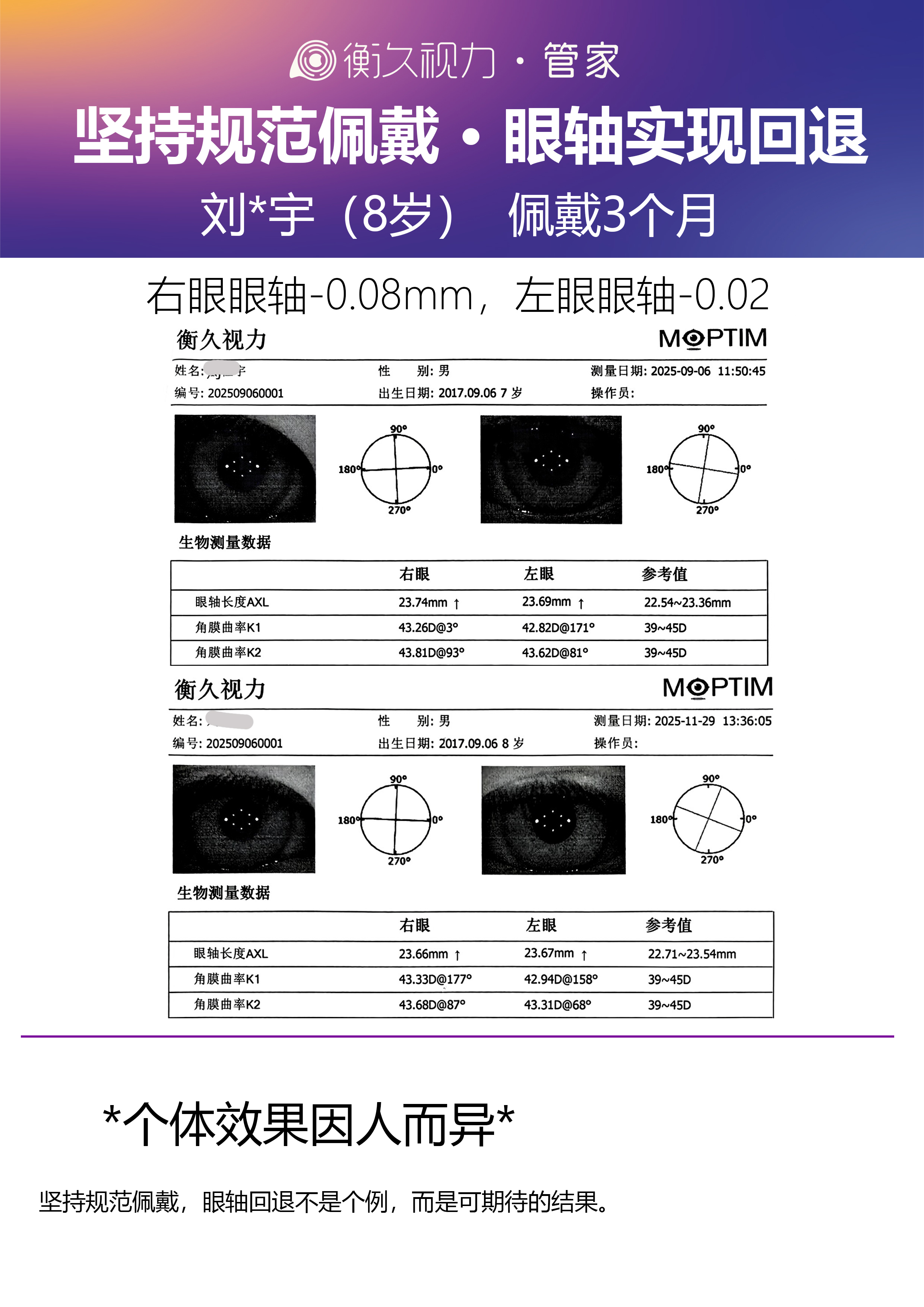 眼轴案例 02