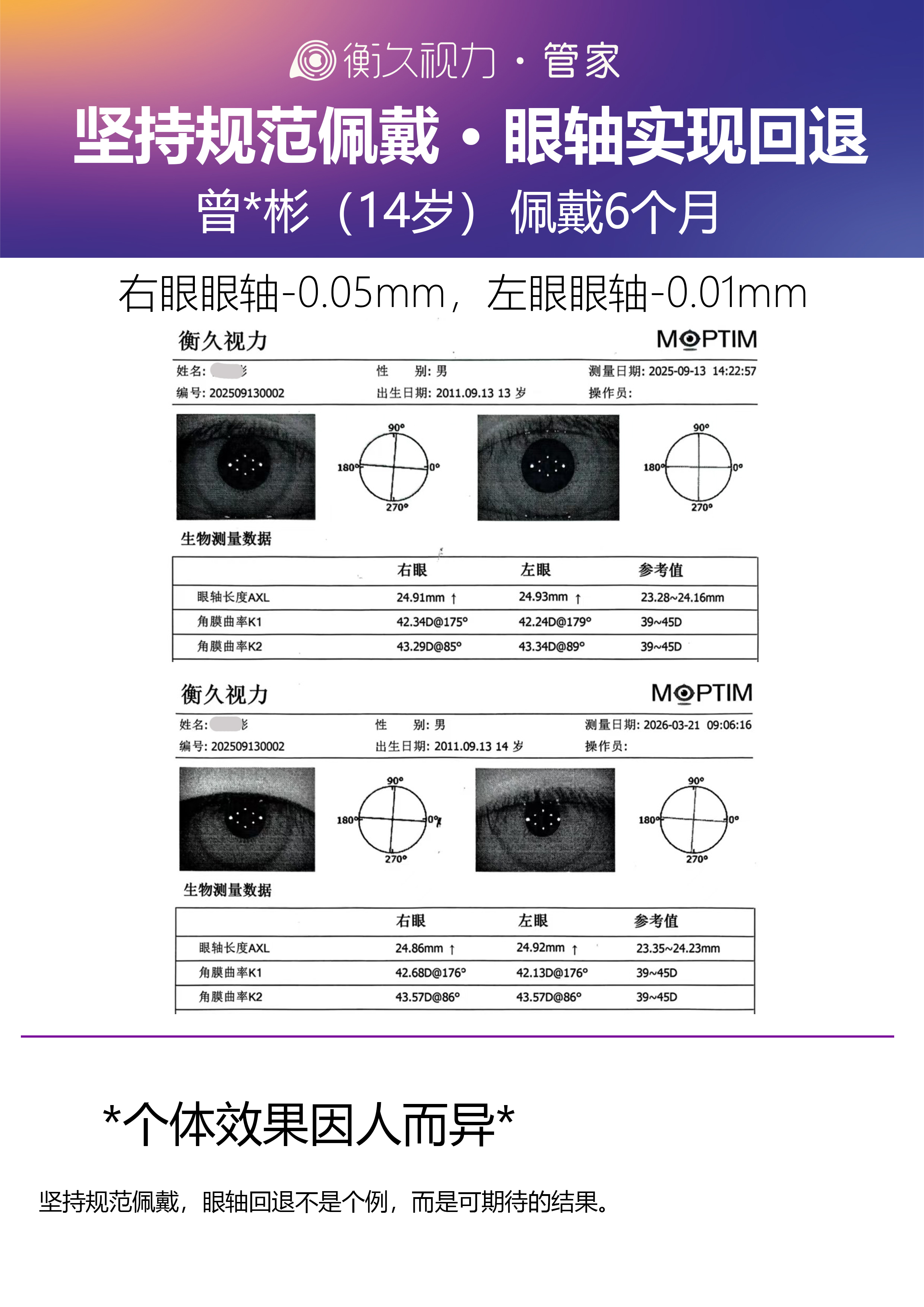 眼轴案例 04