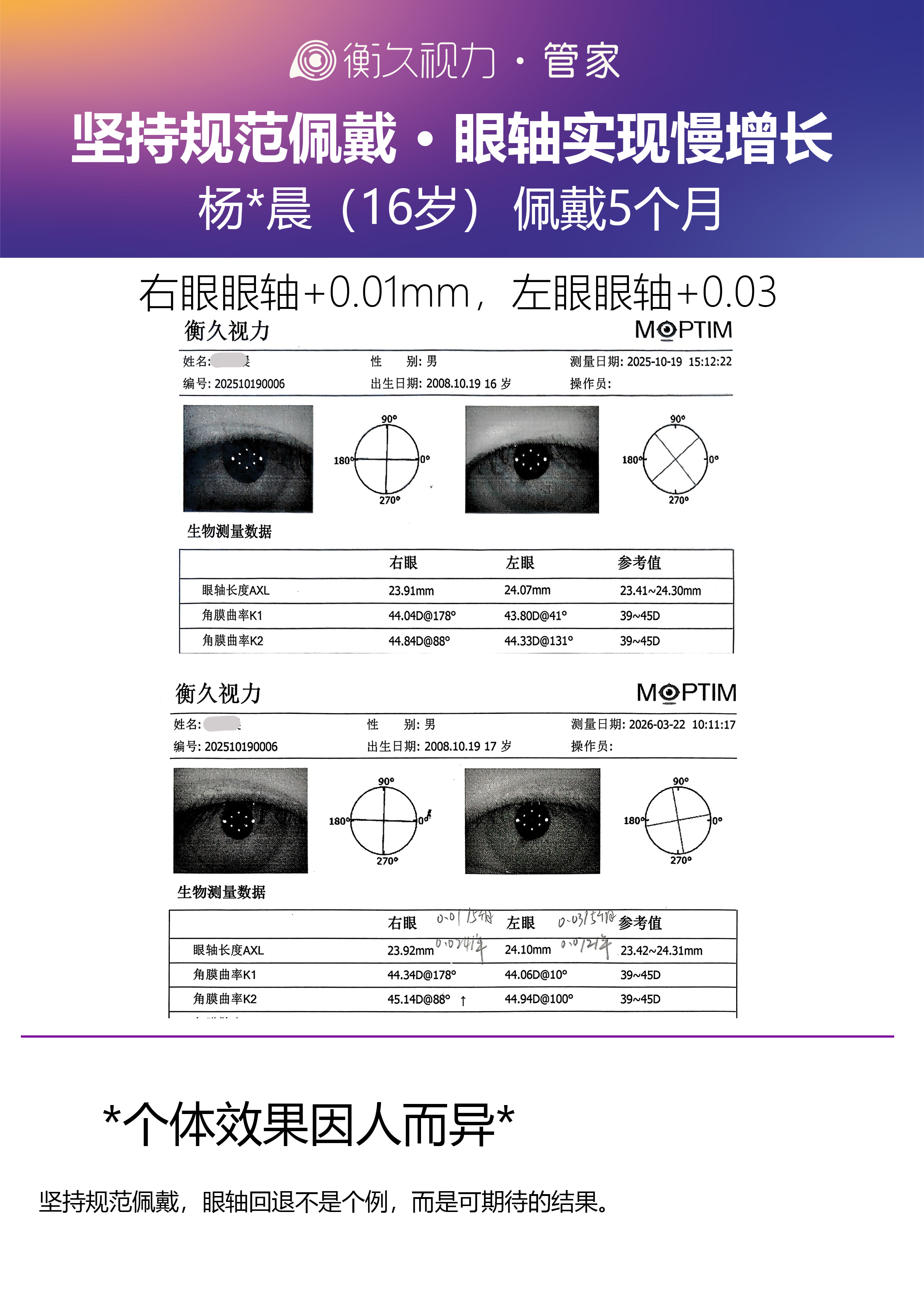 眼轴案例 05