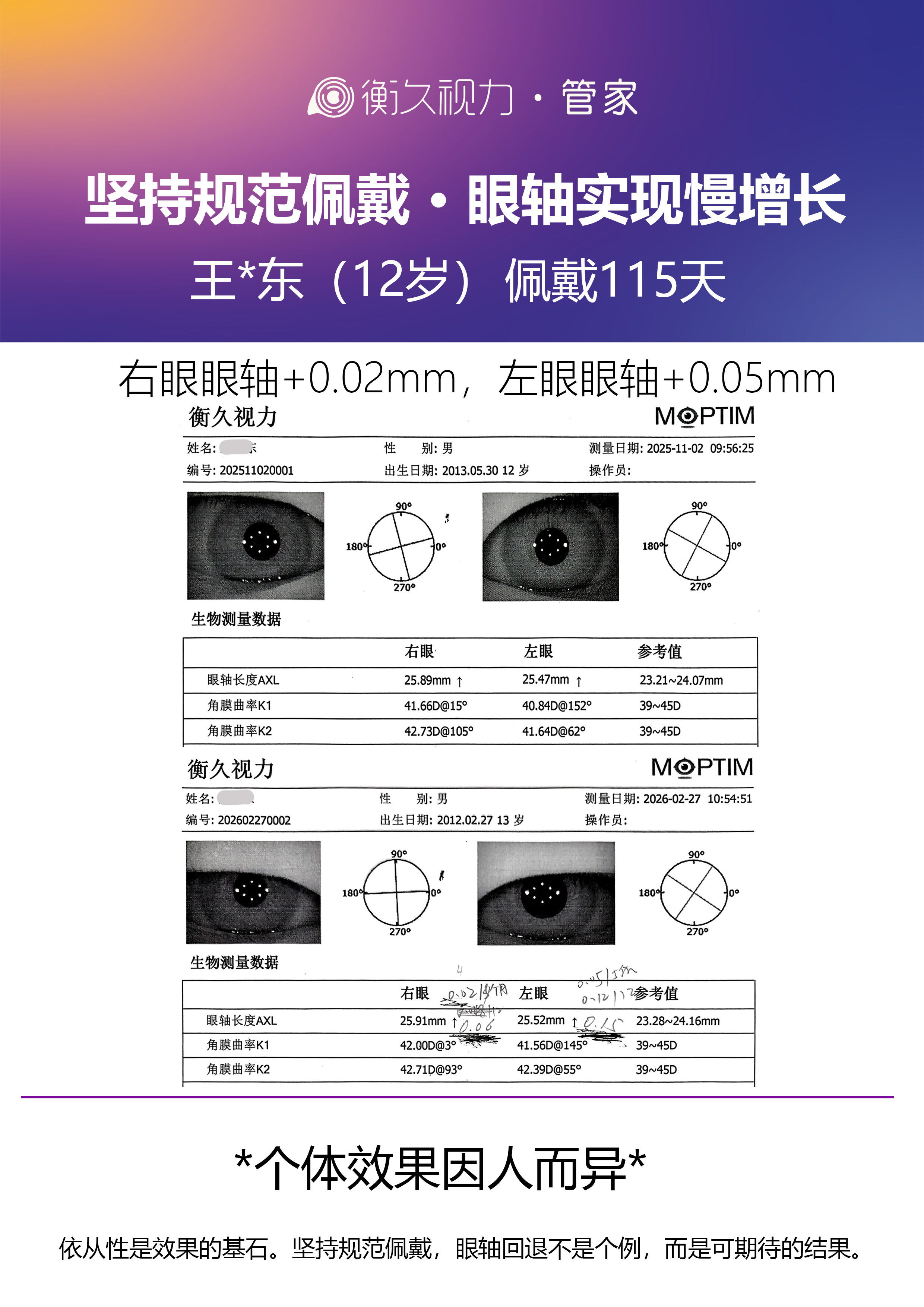 眼轴案例 06