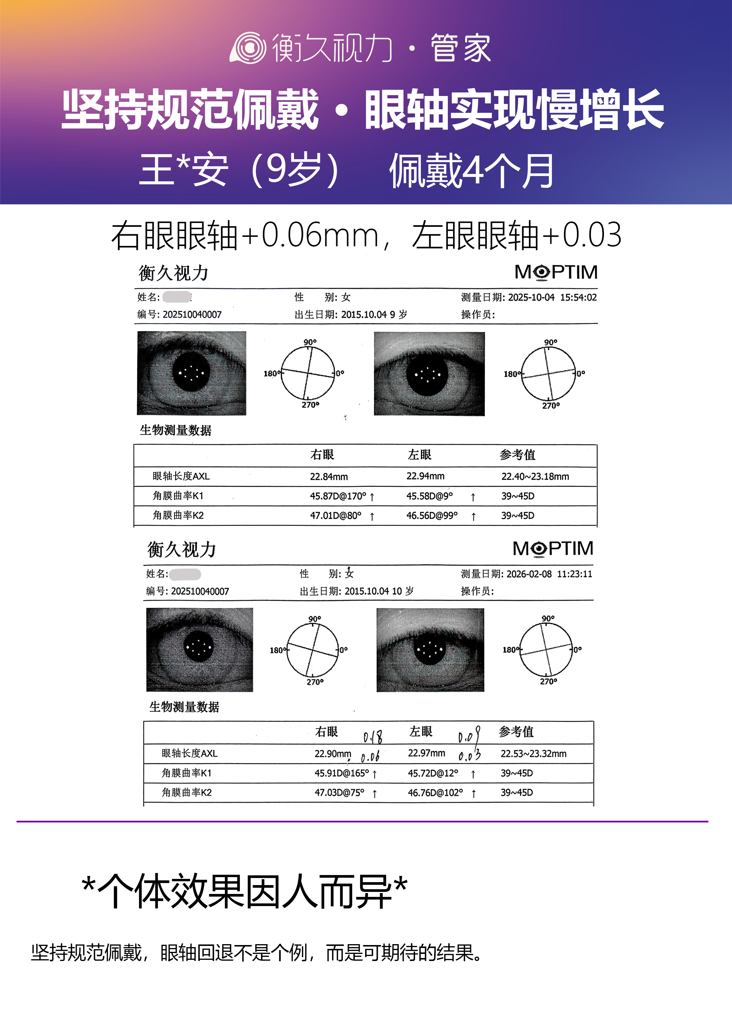 眼轴案例 08
