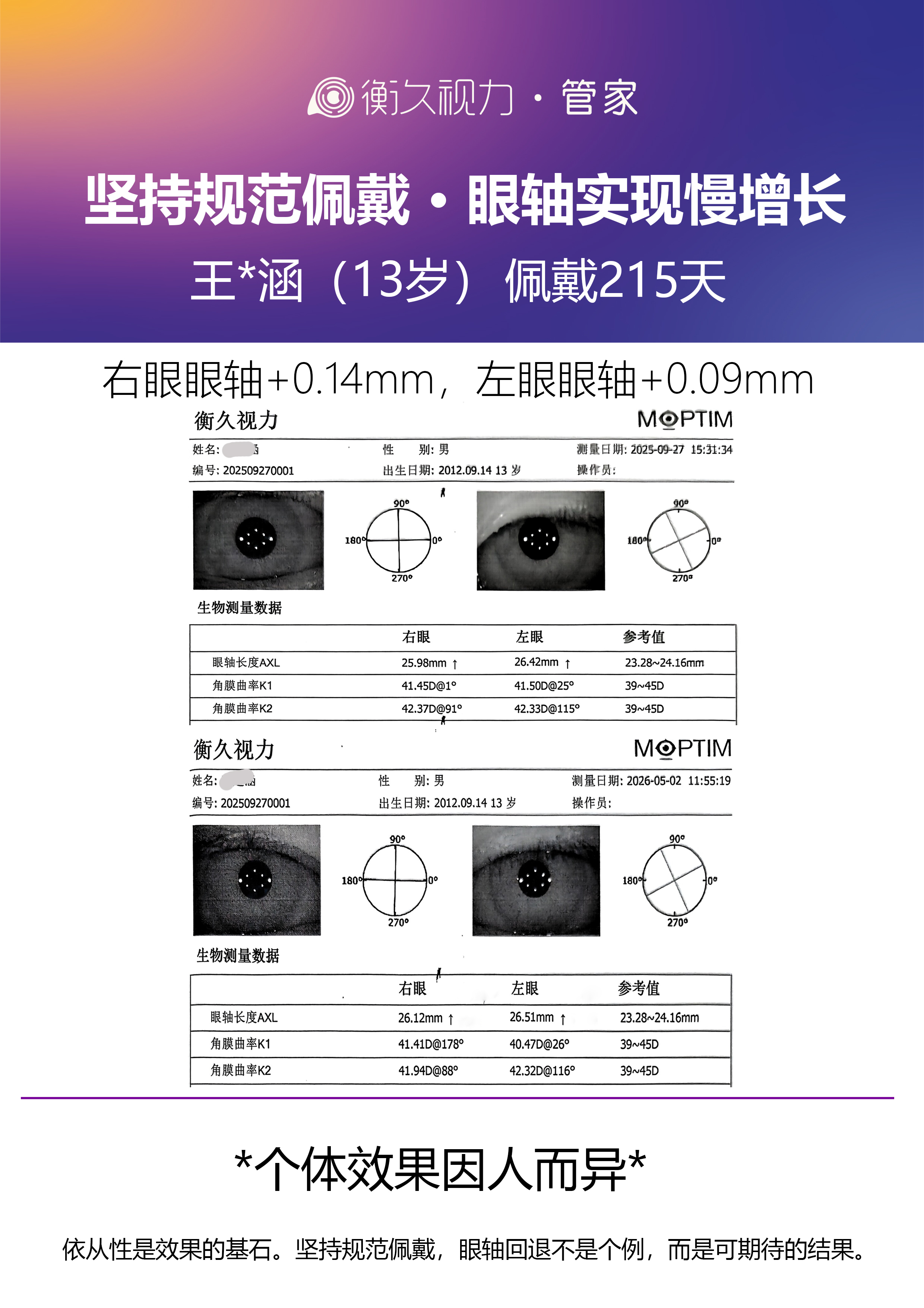 眼轴案例 09