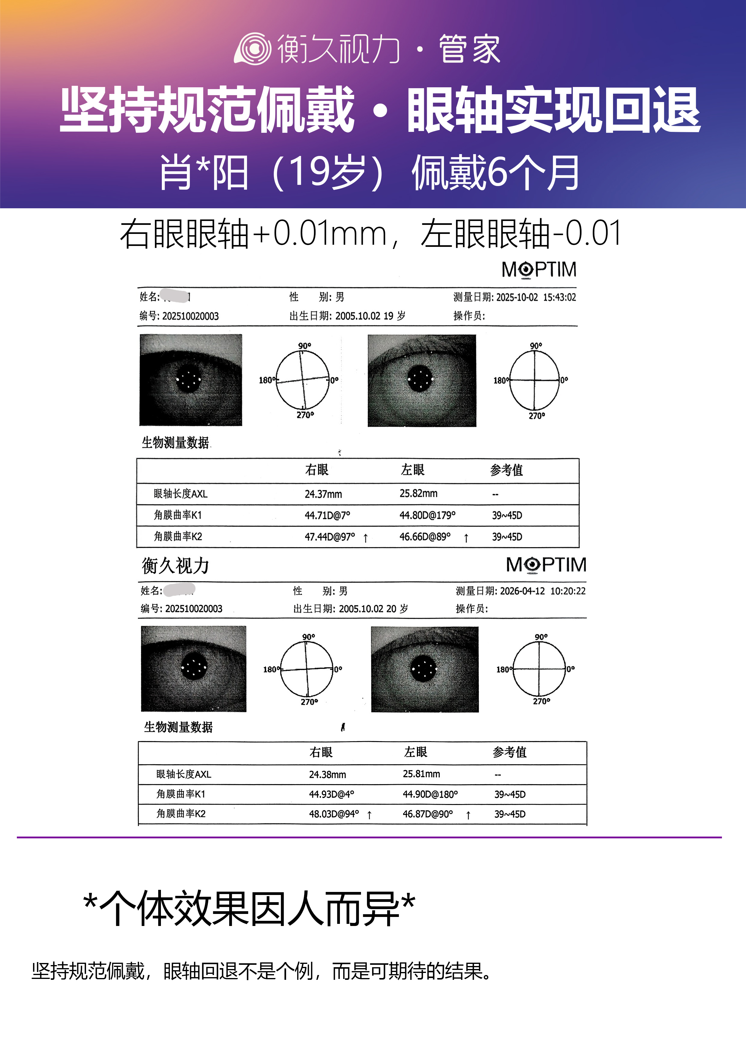 眼轴案例 11