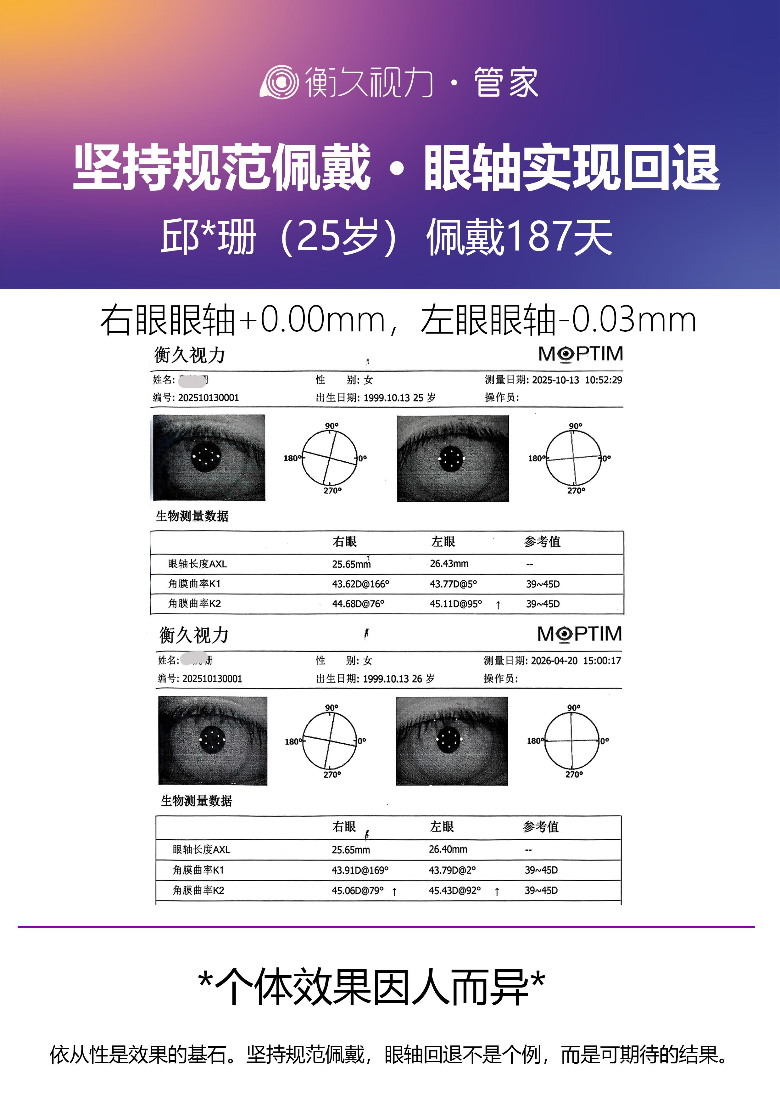 眼轴案例 14