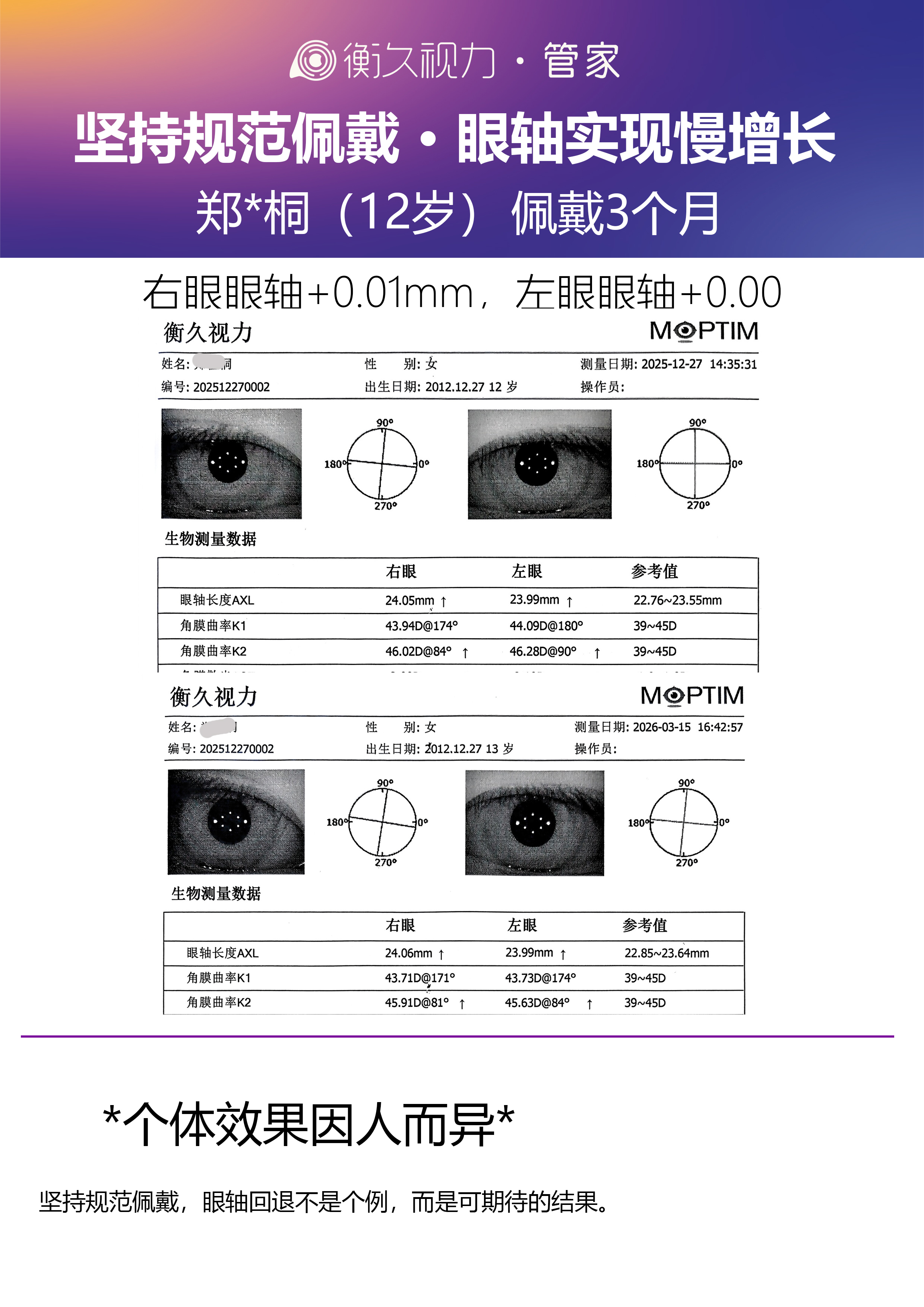 眼轴案例 15