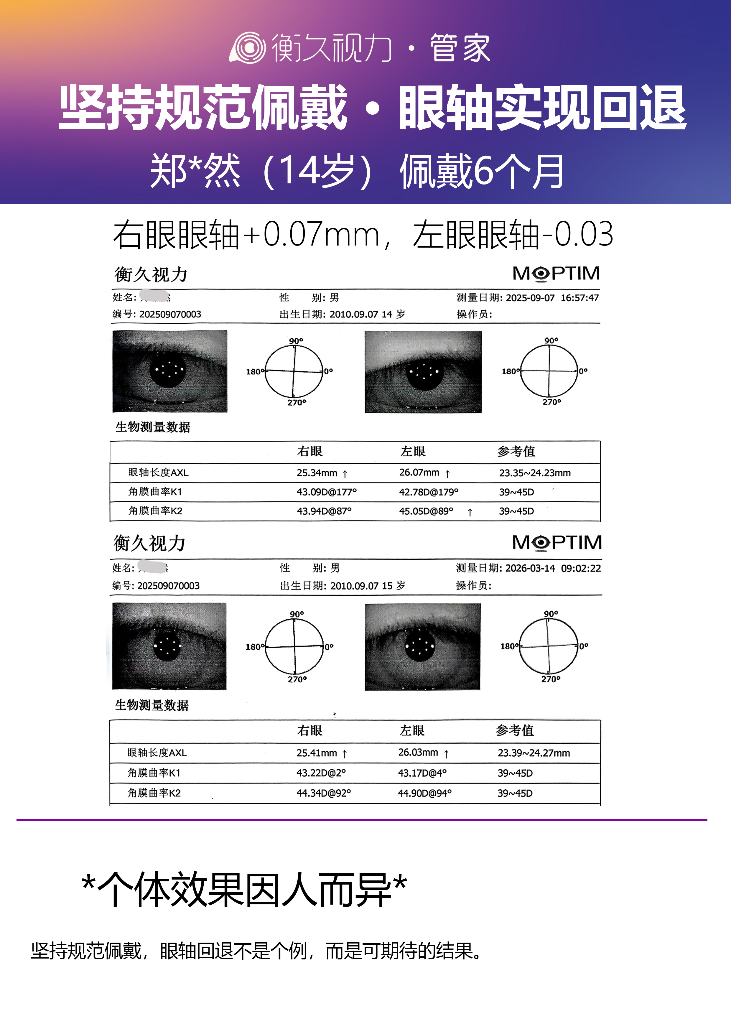眼轴案例 16