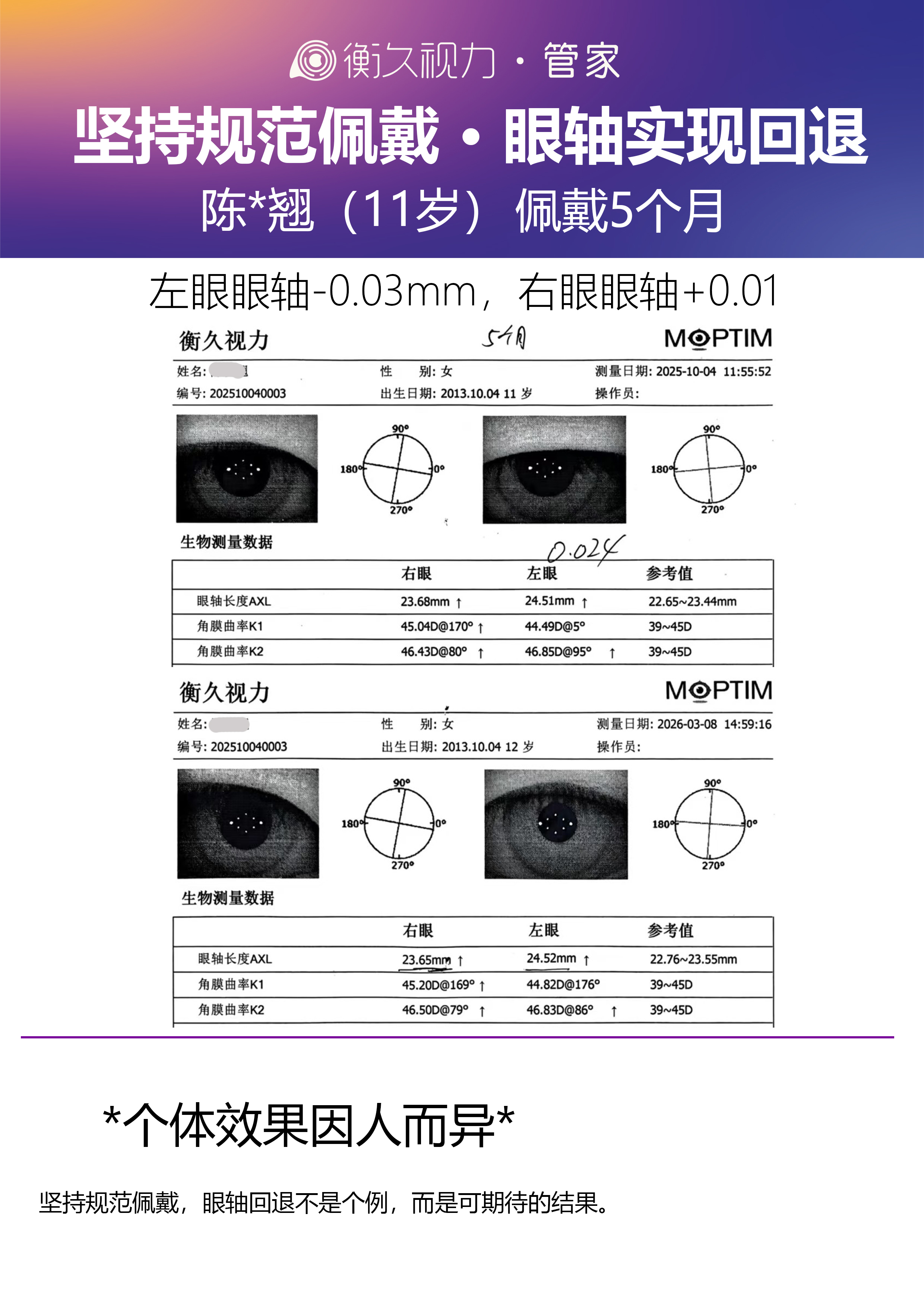 眼轴案例 17
