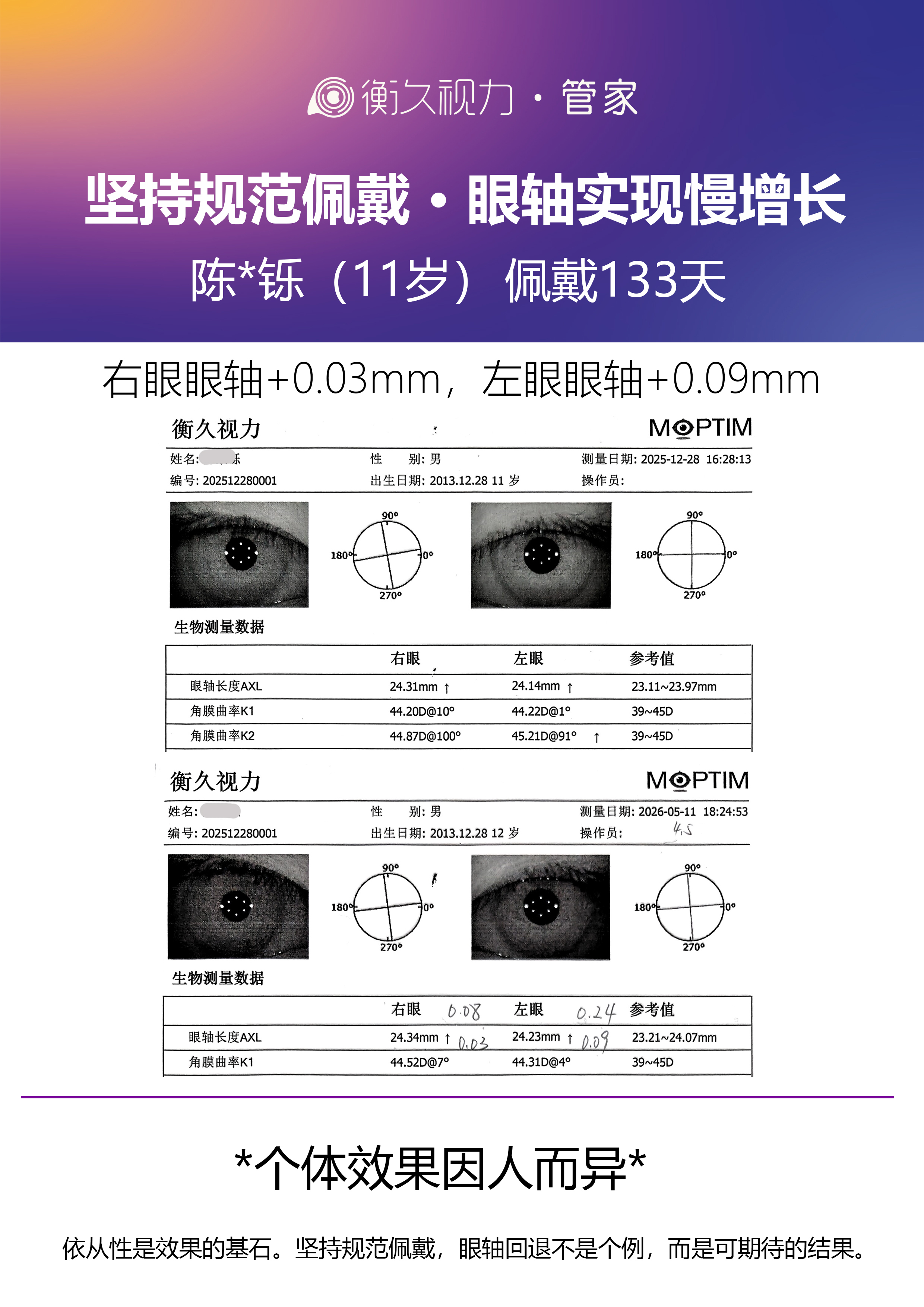 眼轴案例 18