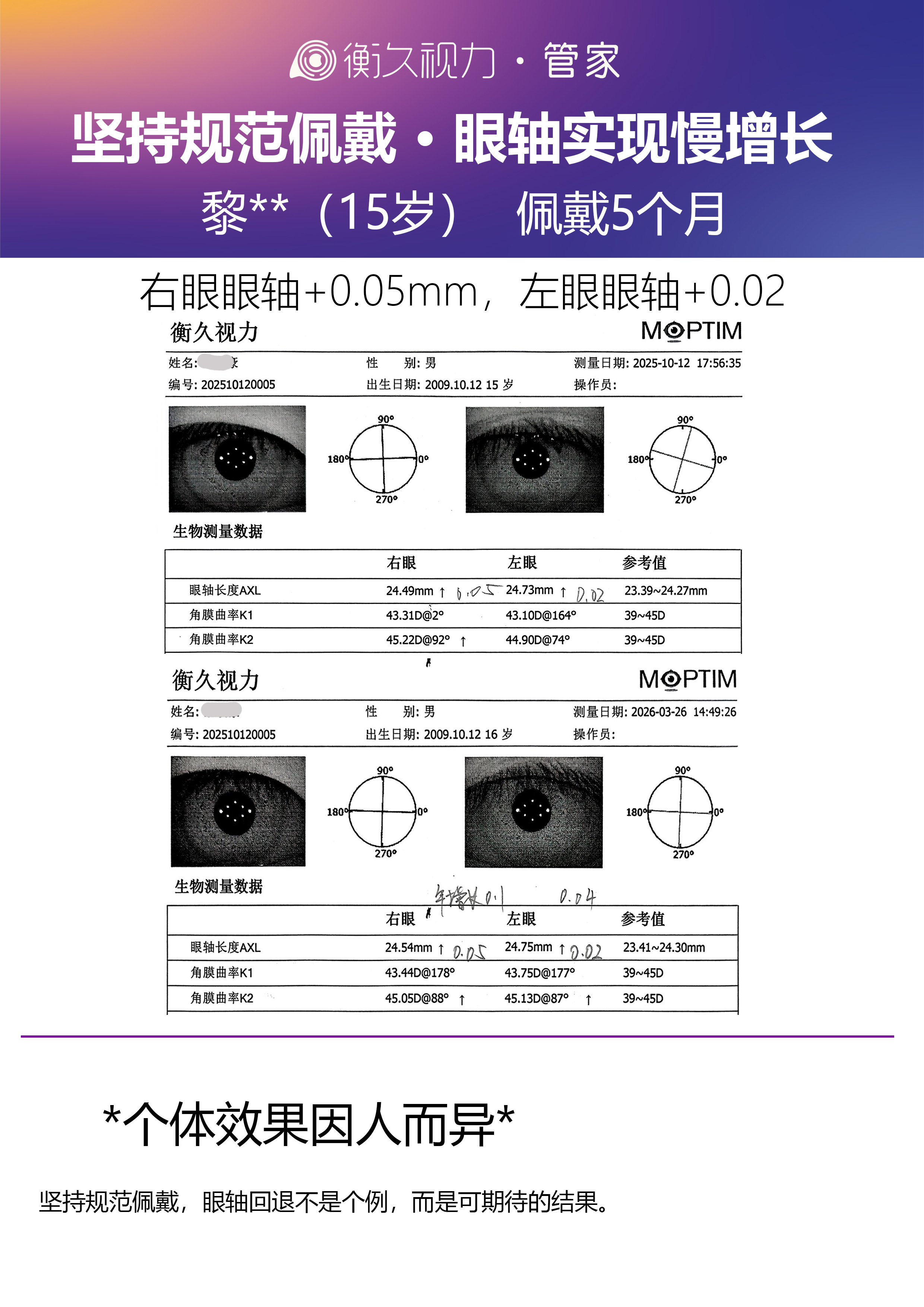 眼轴案例 20